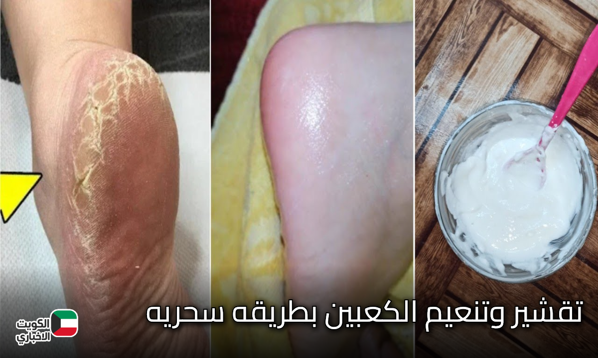 كعبك هينور.. تقشير وتنعيم الكعبين بطريقه سحريه وبمكونات طبيعيه مش هتروحي لكوافير تانى