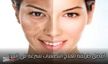 (نتيجة مضمونه) افضل طريقة لعلاج التصغبات بسرعه في البيت في اسبوع واحد